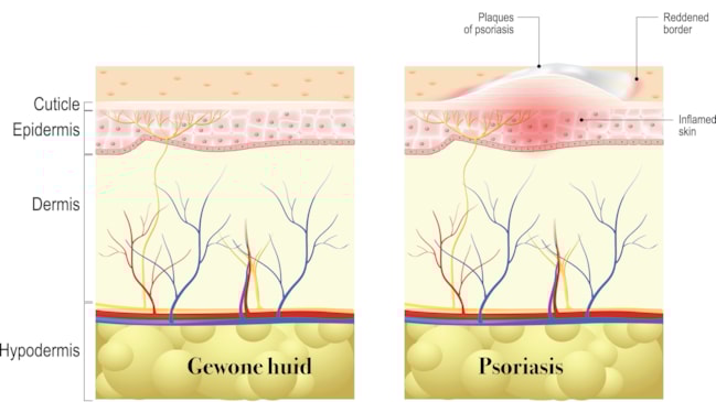 Psoriasis 29-10