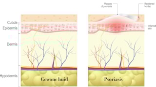 Psoriasis 29-10