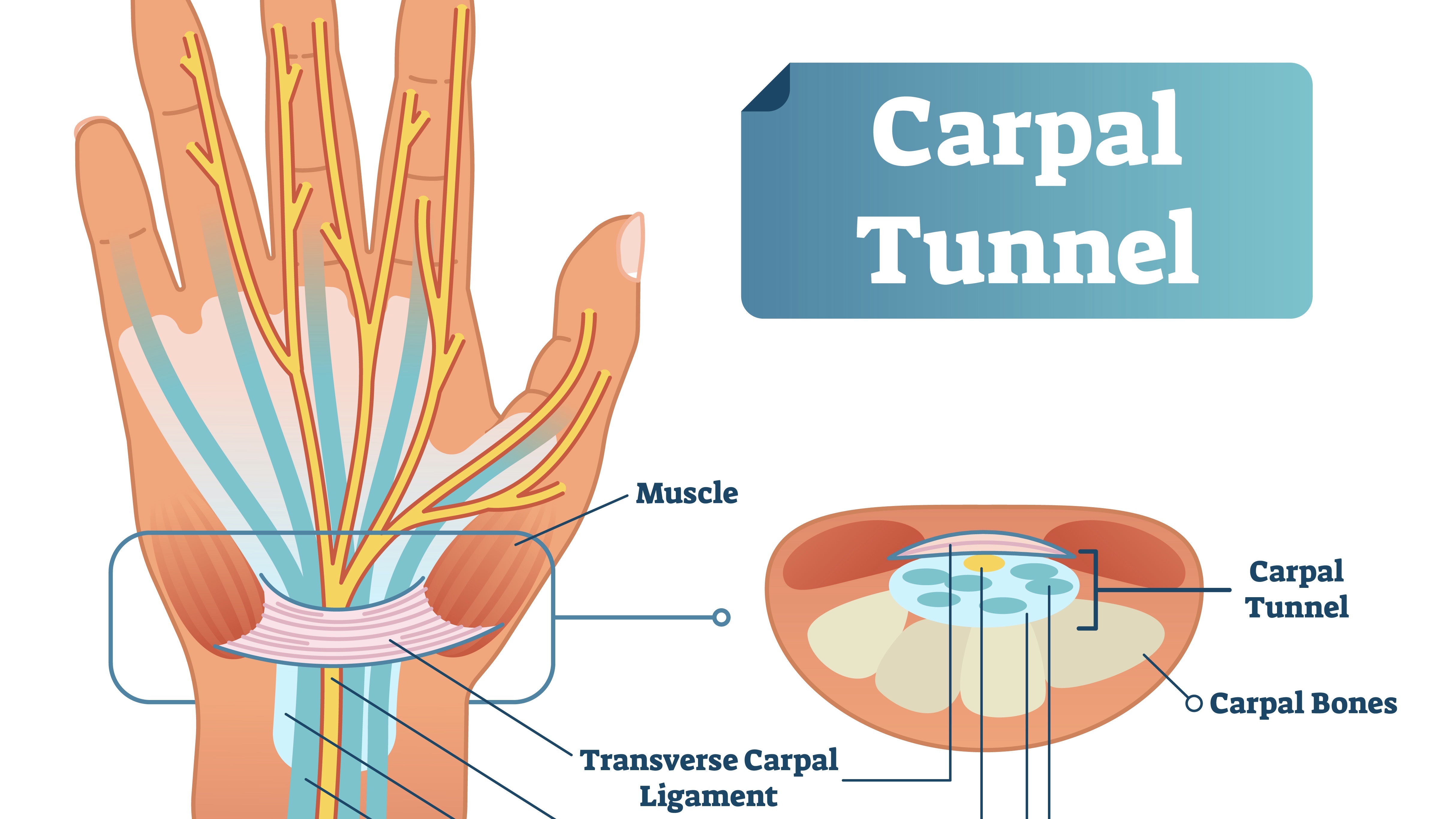 Last van tintelingen in de hand?