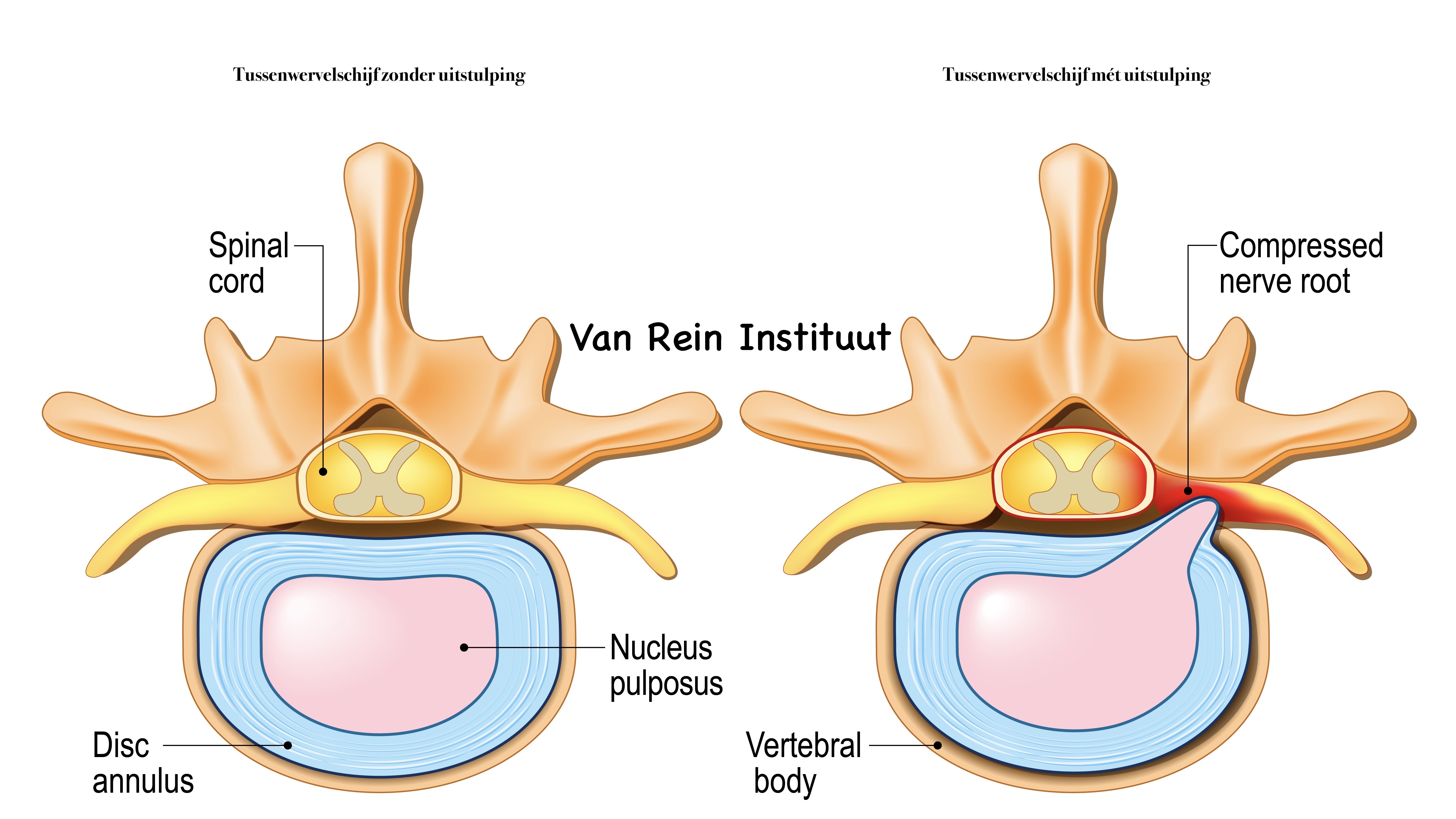 Help! Ik heb een hernia...