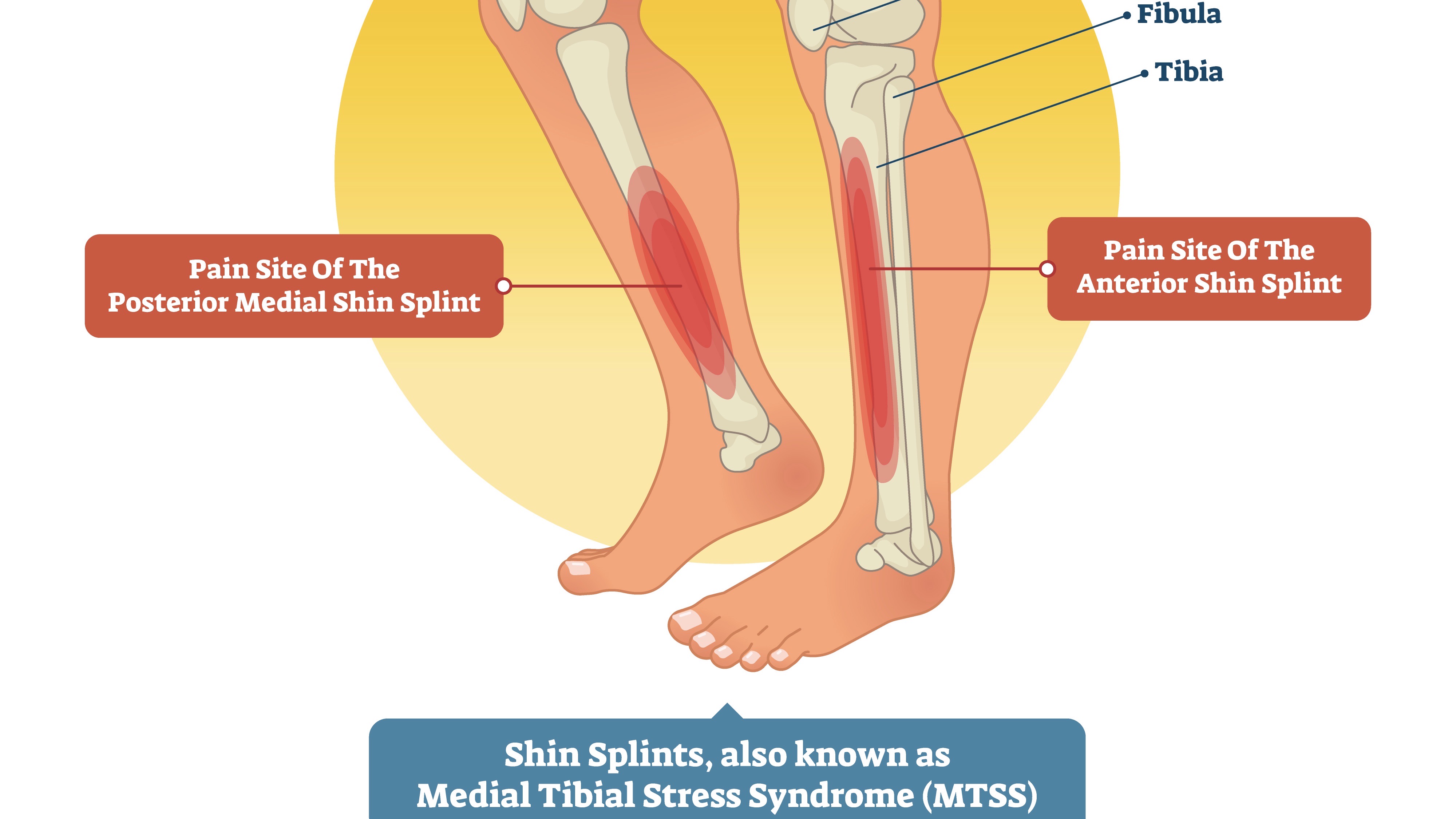Last van je scheenbeen tijdens het sporten?