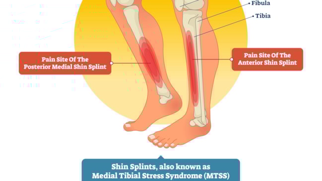 Shin splint