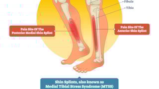 Shin splint